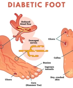 Oveallgo SugarDown Diabetes Foot Pads