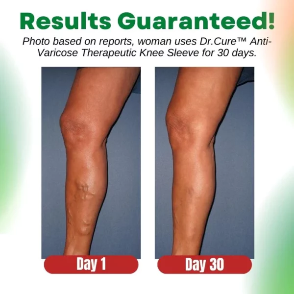 Dr.Cure Anti-Varicose Therapeutic Knee Sleeve