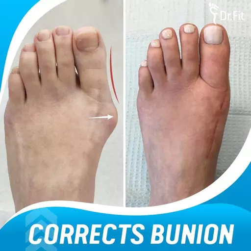 AEXZR Silicone Bunion Corrector