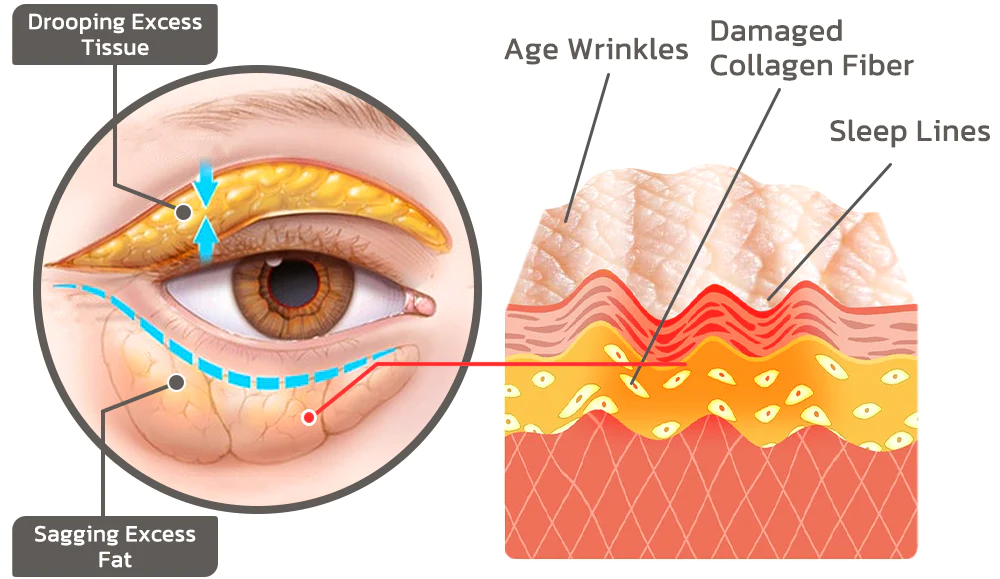 flysmus Milkia Spot Removal Lifting Eye Gel