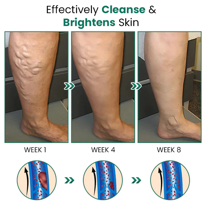 EL VITA Varicose Veins Treatment Soap