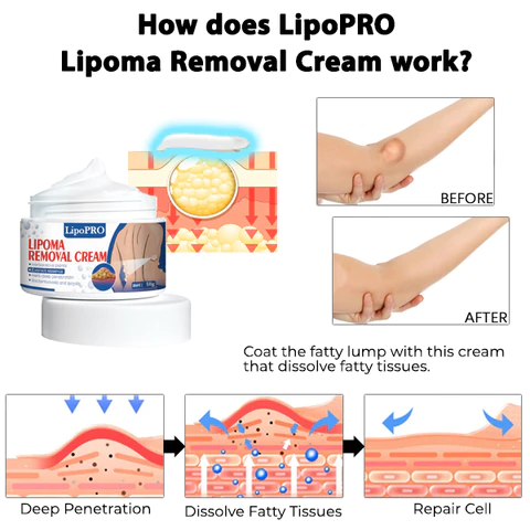 LipoPRO Lipoma Removal CreamLimited Time Discount  Last Day