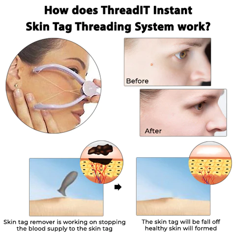 ThreadIT Instant Skin Tag Threading System