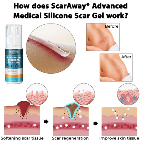 ScarAwayŽ Advanced Medical Silicone Scar Gel