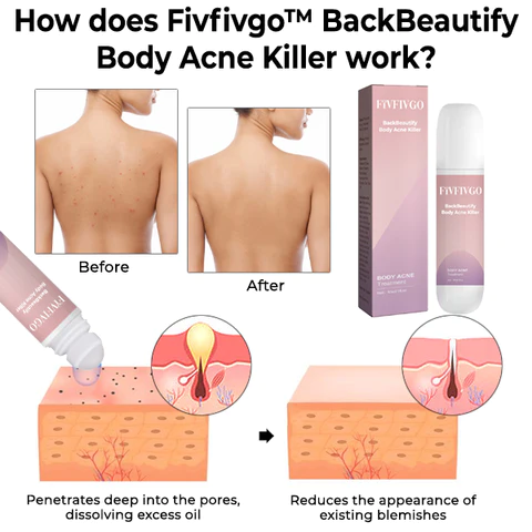 Oveallgo BackBeautify Body Acne Killer