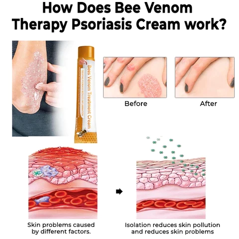 Oveallgo Bee Venom Therapy Psoriasis Cream