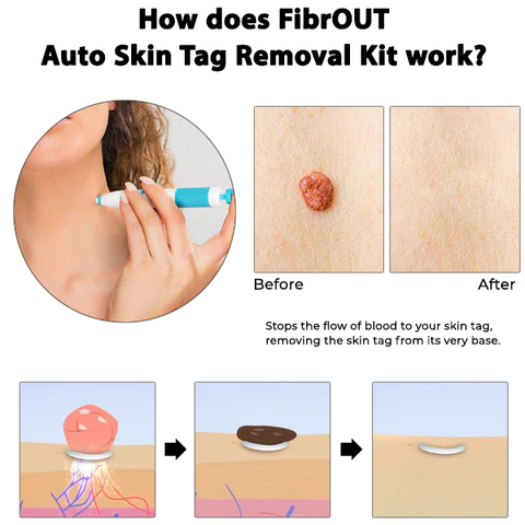 FibrOUT Auto Skin Tag Removal Kit