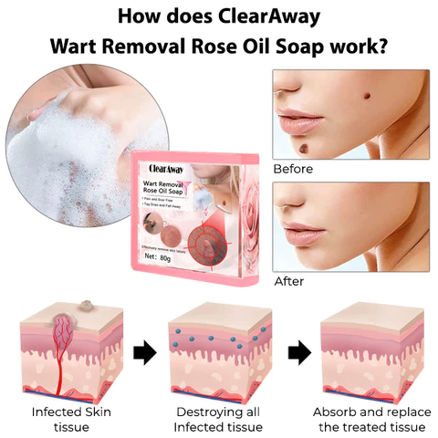 ClearAway PRO Wart Removal Rose Oil Soap