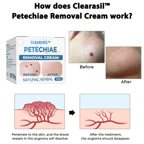 Clearasil Petechiae Removal Cream