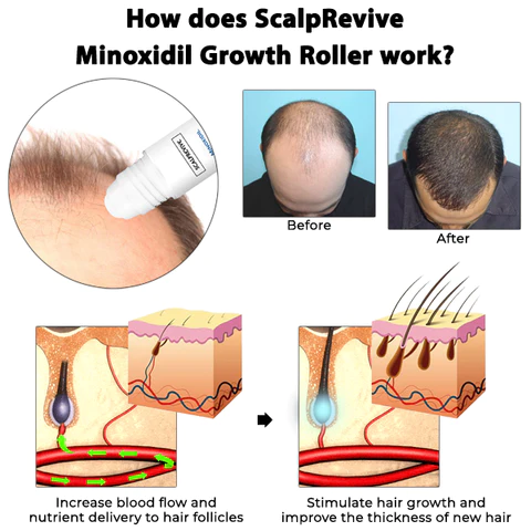 Oveallgo ScalpRevive PRO Minoxidil Growth Roller