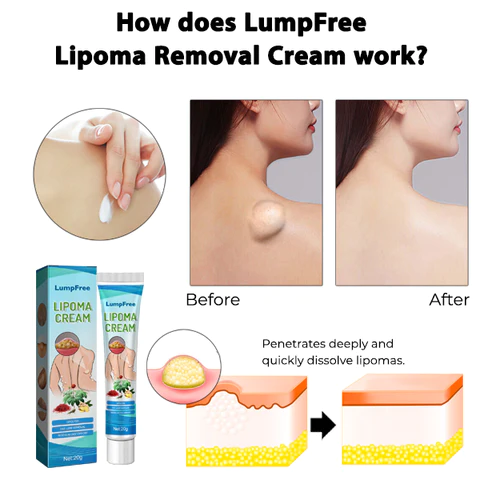 DermaFix Lipoma Removal Cream