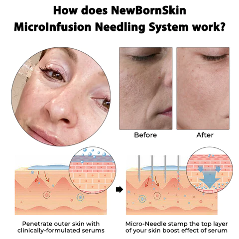 Oveallgo NewBornSkin MicroInfusion Needling System