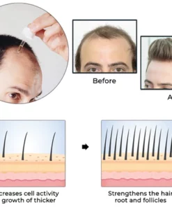 Oveallgo Minoxidil Hair Regrowth Treatment