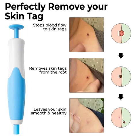 FibrOUT Auto Skin Tag Removal Kit