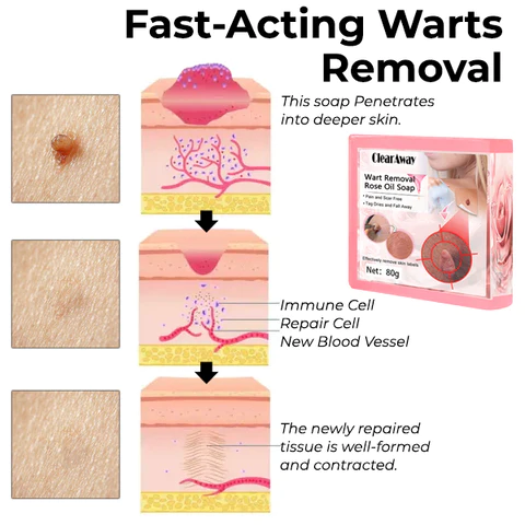 ClearAway PRO Wart Removal Rose Oil Soap