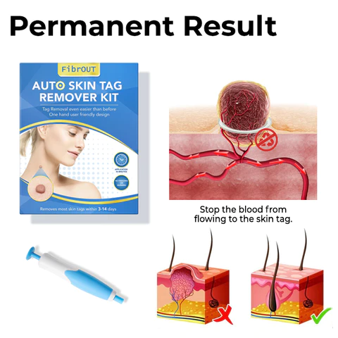 FibrOUT Auto Skin Tag Removal Kit