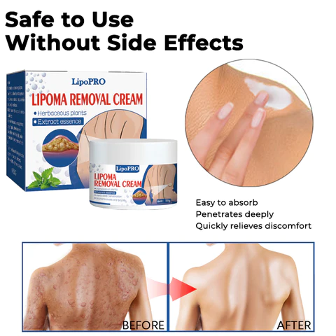 LipoPRO Lipoma Removal CreamLimited Time Discount  Last Day