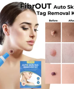 FibrOUT Auto Skin Tag Removal Kit