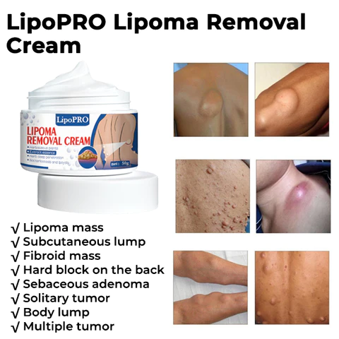 LipoPRO Lipoma Removal CreamLimited Time Discount  Last Day