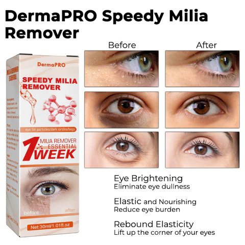 DermaPRO Speedy Milia Remover