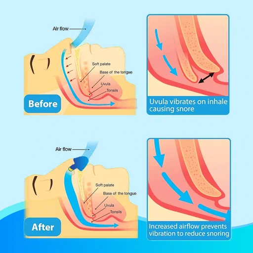 Electric Anti Snoring Device