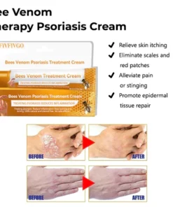 Oveallgo Bee Venom Therapy Psoriasis Cream