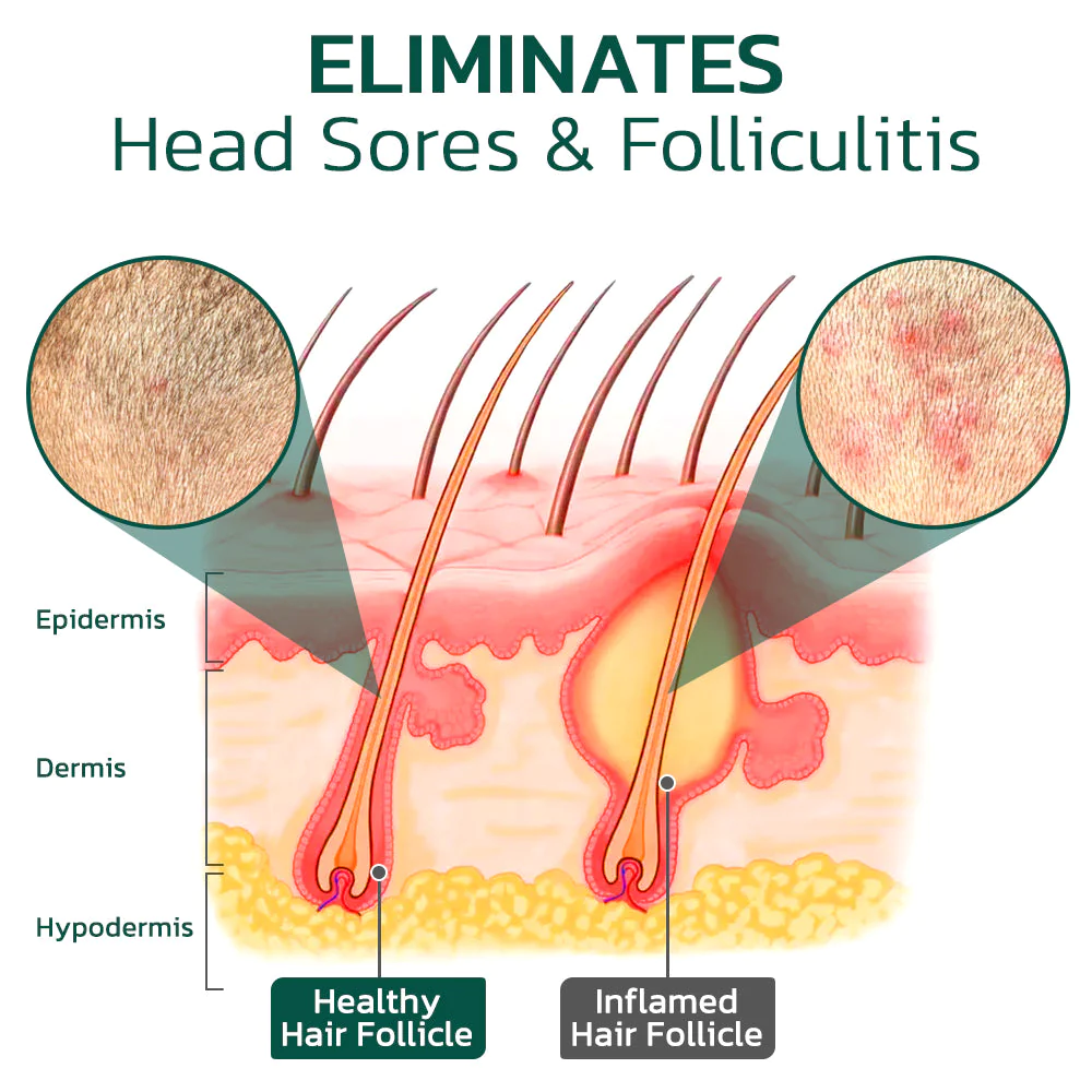 GFOUK Scalp Folliculitis Therapy Oil