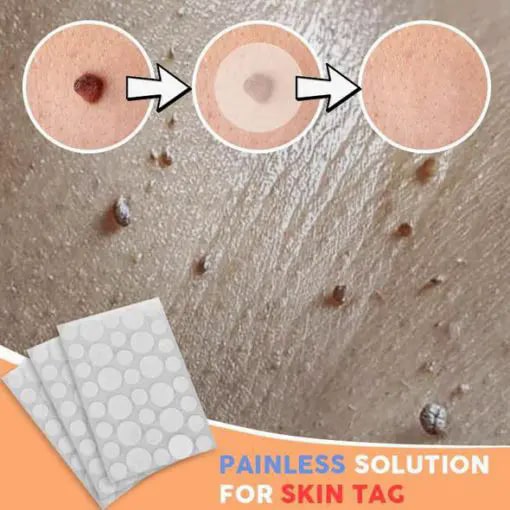 Fibroepithelial Polyp Removal Patch (36 pcs)