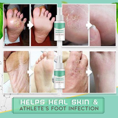 Fresh Foot Deodorant Antifungal Spray