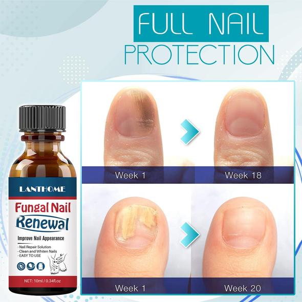 Fungal Nail Renewal Gel