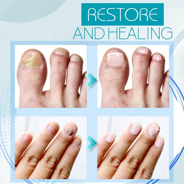 Fungal Nail Renewal Gel