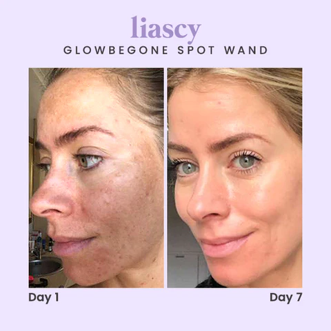 Liascy GlowBeGone Spot Wand