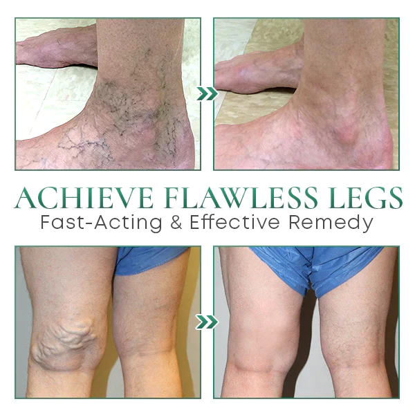 RENEW+ Varicose Veins Cream