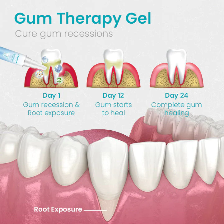 Oveallgo Gum Shield Therapy Gel