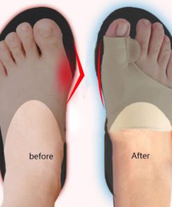 Orthopedic Bunion Corrector