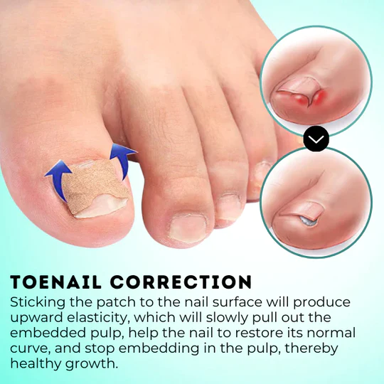 HealPatch Ingrown Toenail Corrector