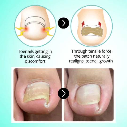 HealPatch Ingrown Toenail Corrector