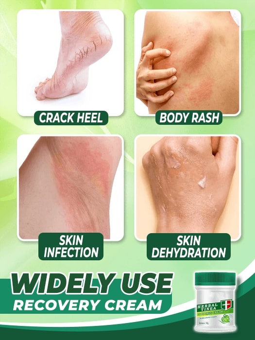 Herbal Tinea Corporis Cream