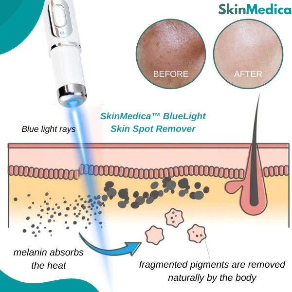 SkinMedica BlueLight Skin Spot Remover