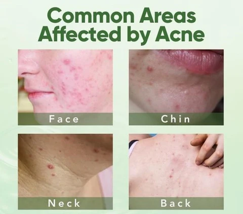 AEXZR Acne Removal Gel