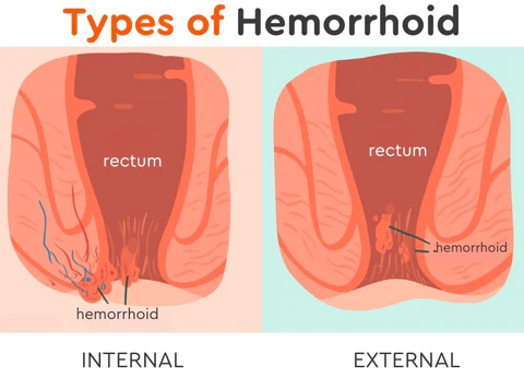 RectiCare Hemorrhoid & Fissure Cream