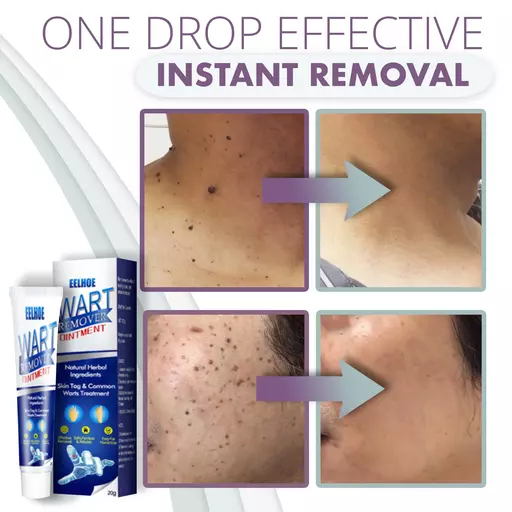 Instant Skin Tag Removal Mousse