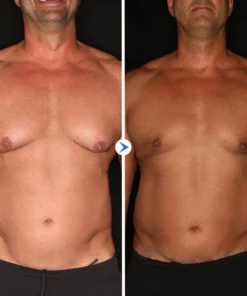 Gyno Out Chest Tightening Spray