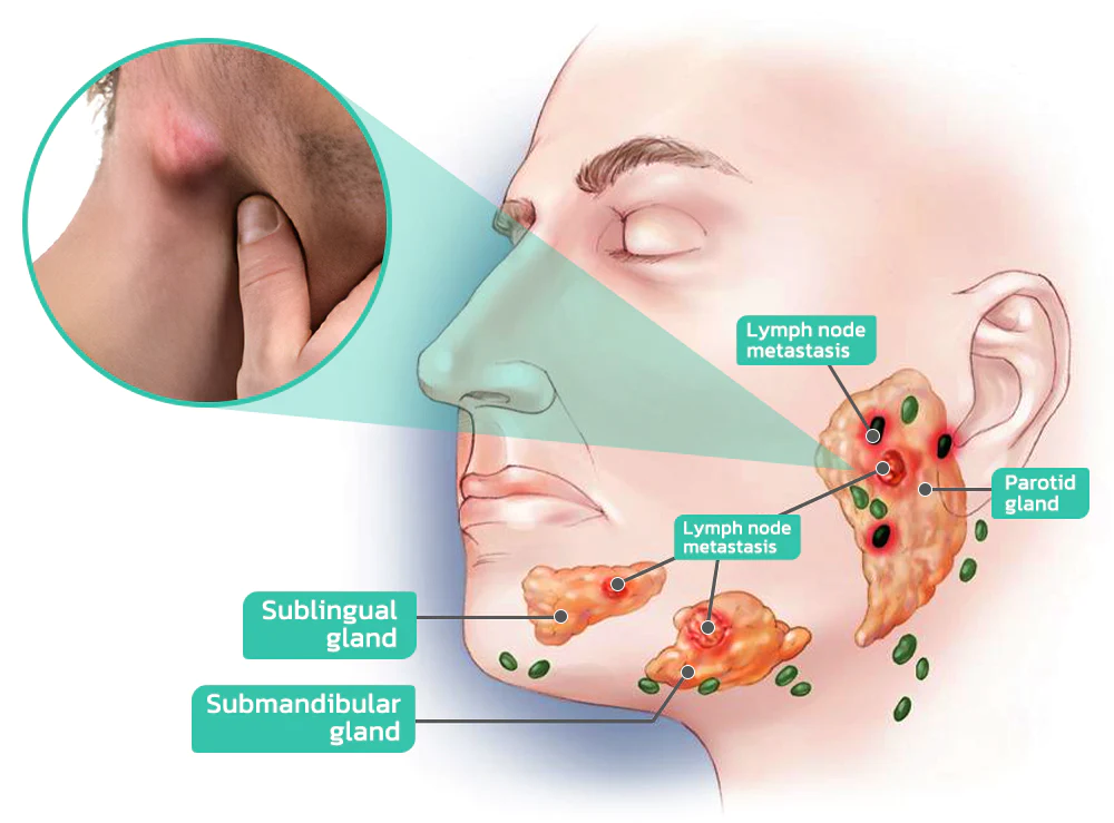 GFOUK Mandibular lymph Nodes Treatment Roller Cream