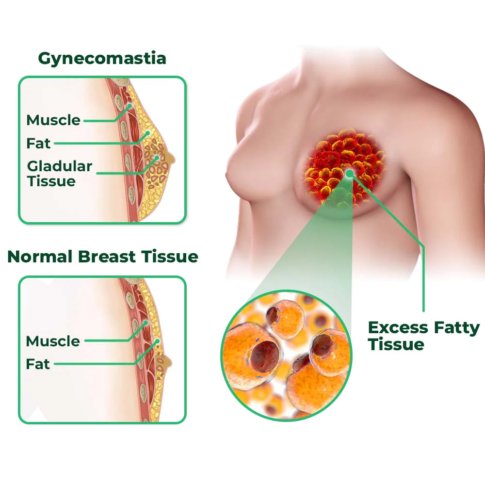 GFOUK GynoReduct Gynecomastia Diminishing Patch