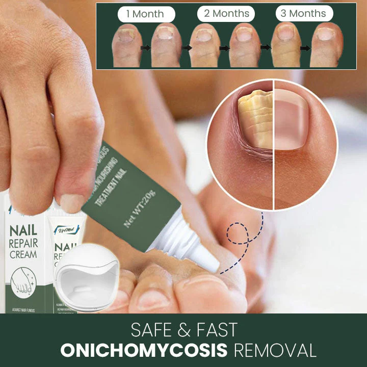 LifeMed Home Use Onychomycosis Fungal Laser Treatment