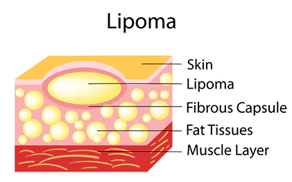 DermaFix Lipoma Removal Cream