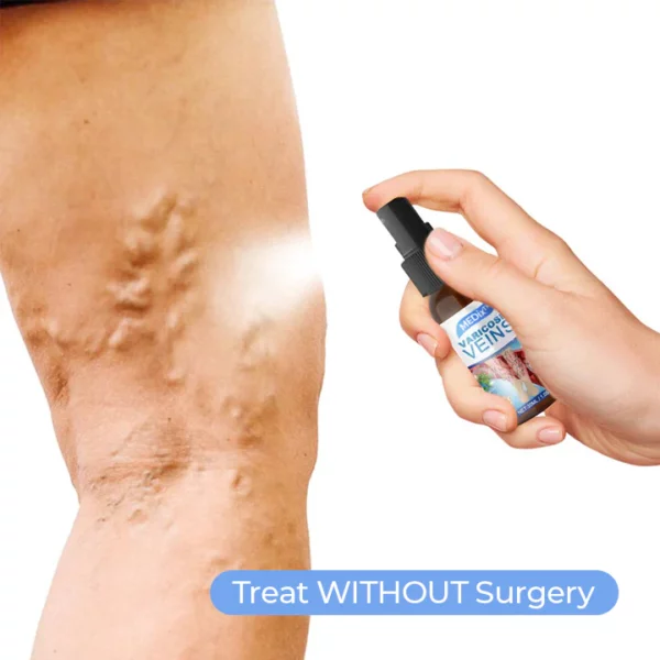 MEDix Varicose Veins Spray