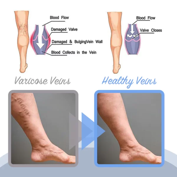 MEDix Varicose Veins Spray