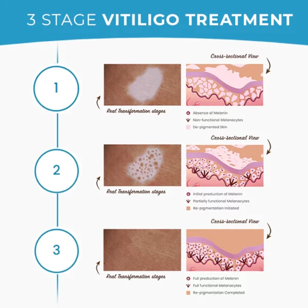 MEDix Vitiligo Treatment Cream